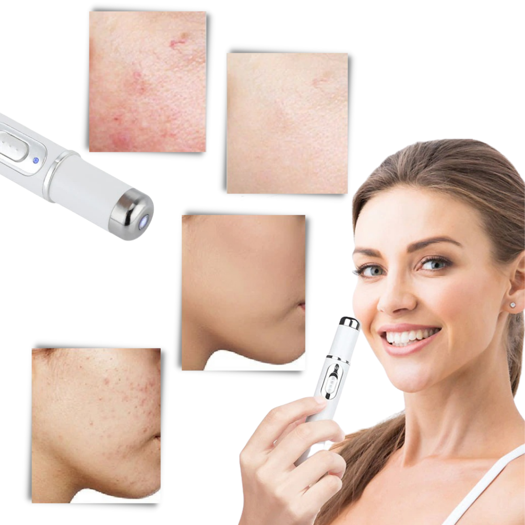 Blue light skin therapy pen